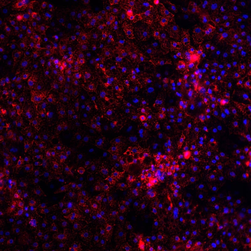 Wilsons Disease (RGB)-2
