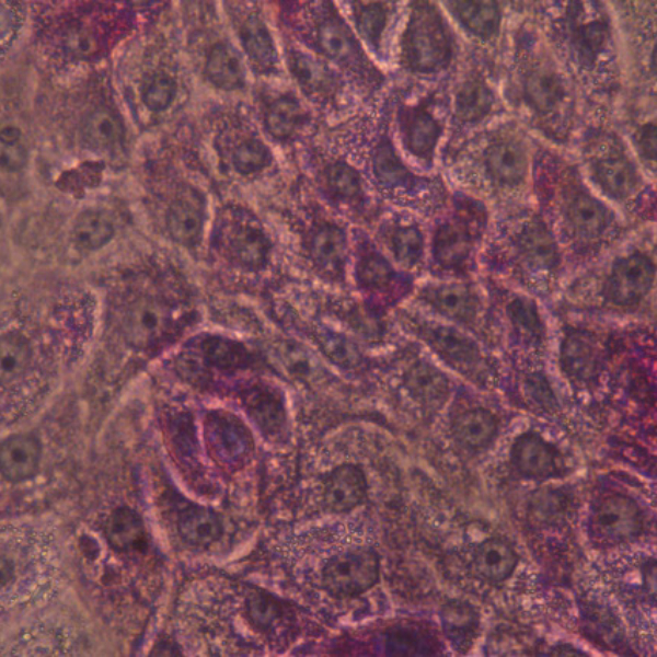 DefiniGEN GSD1a PAS staining showing breakdown of accumulated glycogen_Cell_product_Image_600x600